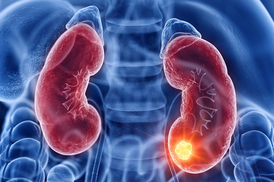 Se encuentra cáncer de riñón como principal causa de muerte