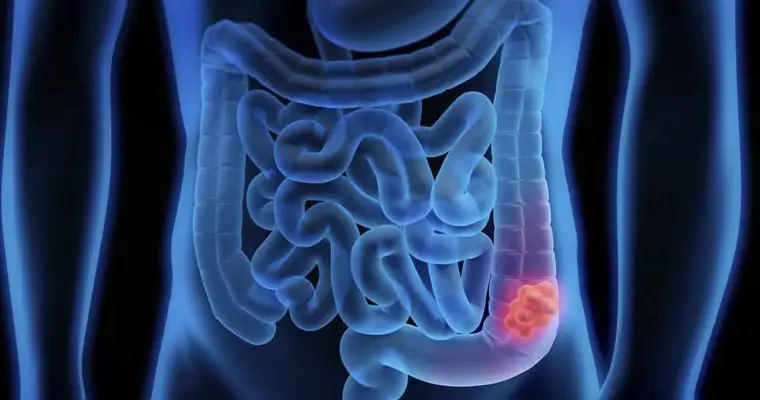 Aumentan casos de cáncer colorrectal a partir de los 40 Aumentan casos de cáncer colorrectal a partir de los 40
